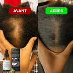 Load image into Gallery viewer, Huile naturelle pour stimuler la pousse des cheveux
